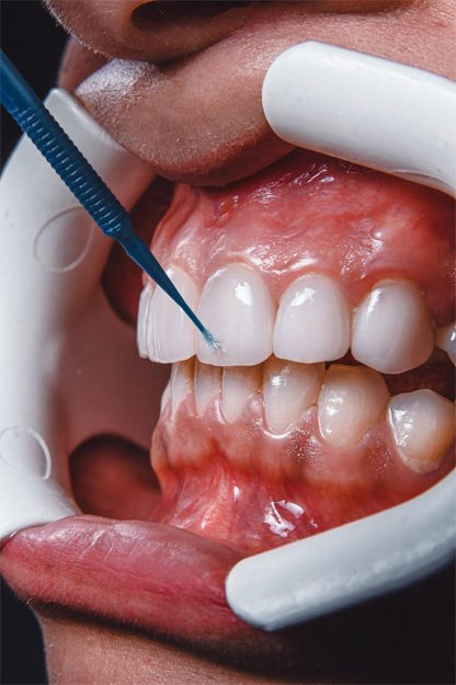 Family dental care clinic Dubai – Teeth whitening services for a brighter smile in Dubai at Somerset Clinic.-Periodontal care for healthy gums and teeth in Dubai at Somerset Clinic.
