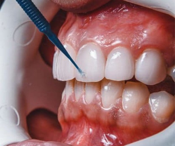 Professional Periodontal Care in Dubai – Gum Disease Treatment and Prevention at Somerset Clinic. Family dental care clinic Dubai – Teeth whitening services for a brighter smile in Dubai at Somerset Clinic.-Periodontal care for healthy gums and teeth in Dubai at Somerset Clinic.